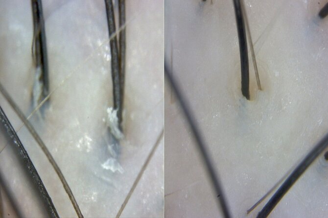 15 Step Stem Cell Scalp Treatment in Seoul - What Is Included and What Costs Extra?